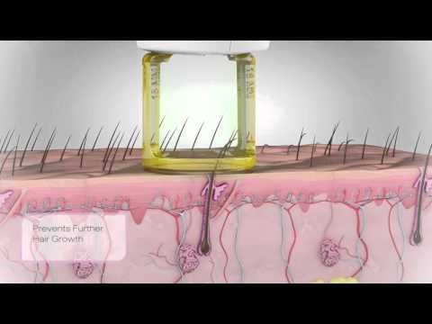 Laser Hair Removal at Pulse Light Clinic London 