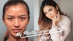 MY PLASTIC SURGERY STORY (PART 3) END RESULT! | BEAUTIQUE KOREA | BANOBAGI CLINIC | BAHASA INDONESIA 
