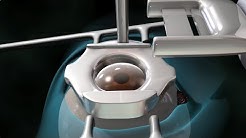Laser Eye Surgery (LASIK) 